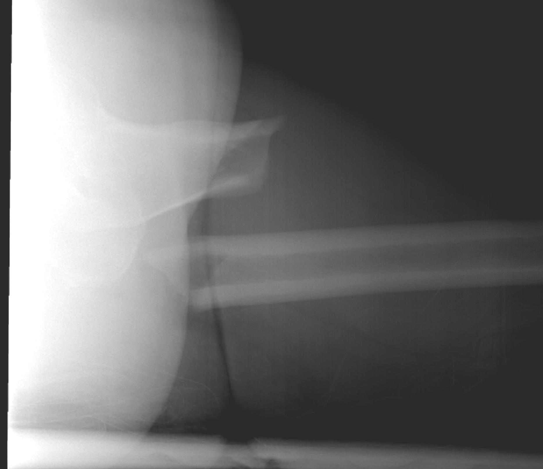 Subtrochanteric Lateral